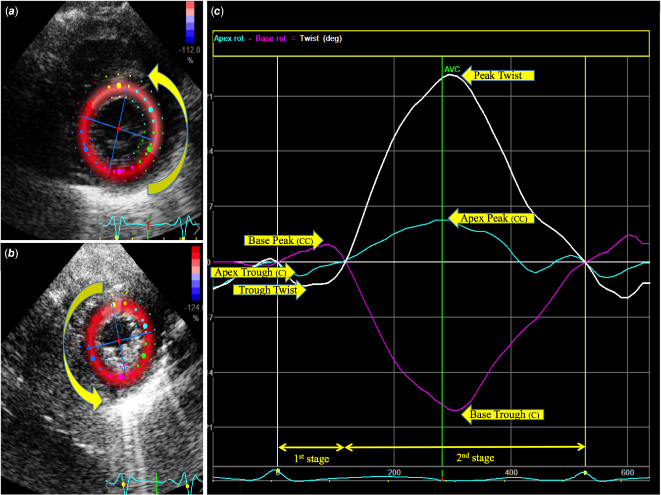 Speckle tracking derived strain in neonates: planes, layers and