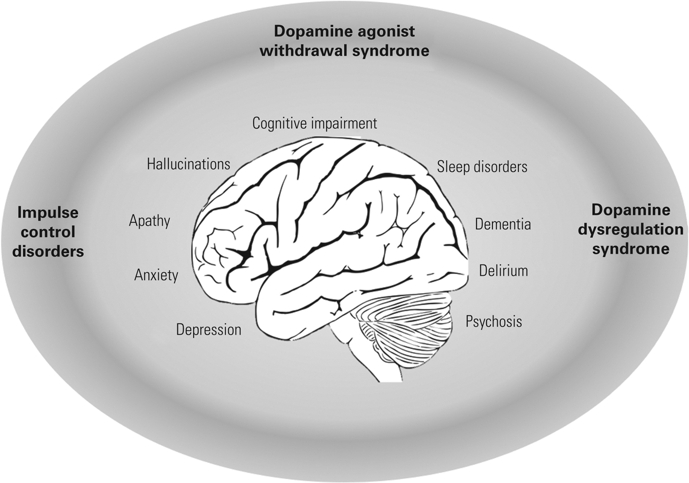 Neuropsychiatric symptoms in Parkinson's disease: aetiology, diagnosis ...