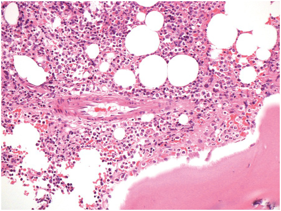 Bone Marrow Biopsy Histology