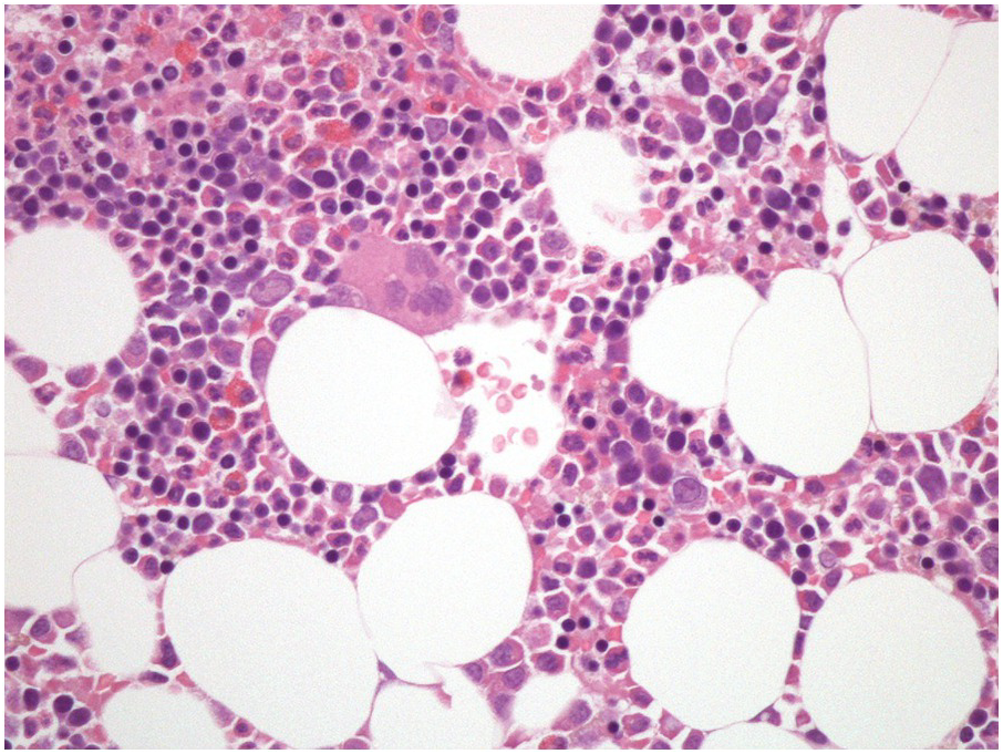 normal bone marrow cells