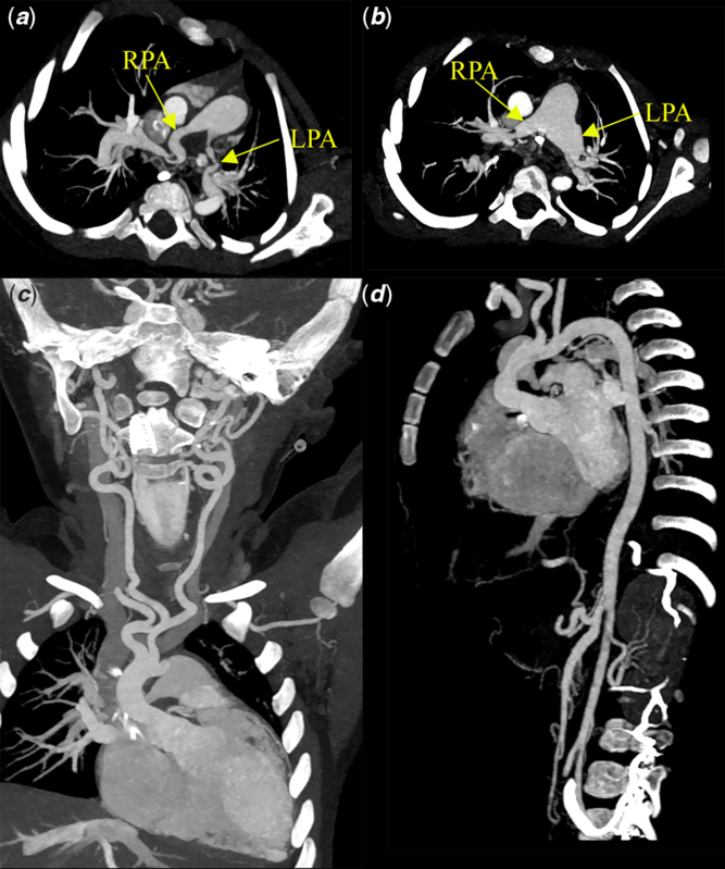 First Antenatally Confirmed Case Of Arterial Tortuosity Syndrome 