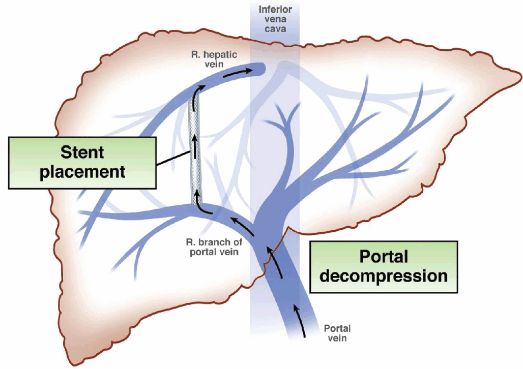Pathophysiology of Pediatric Liver Disease (Section I) - Liver 