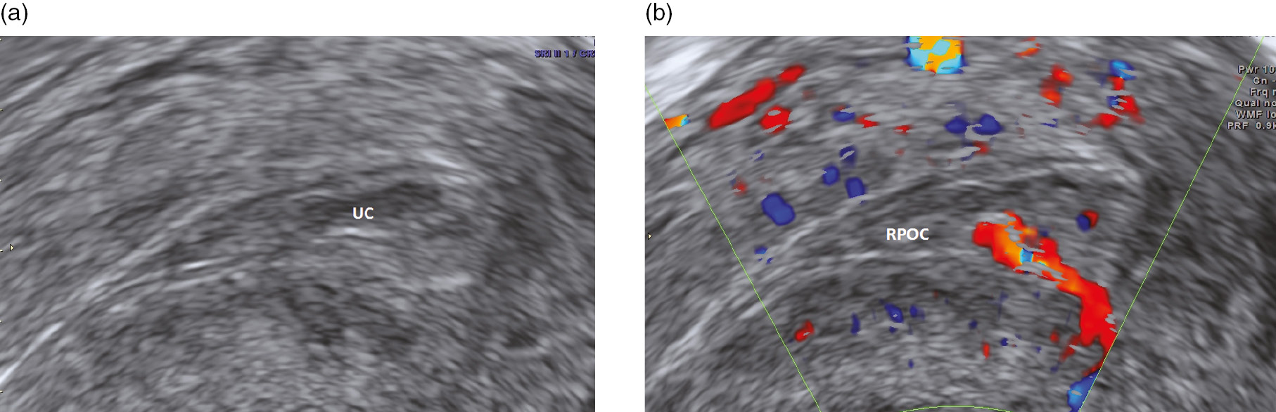 Figure 1 from An Alternative Treatment for the Ovarian Ectopic Pregnancy |  Semantic Scholar