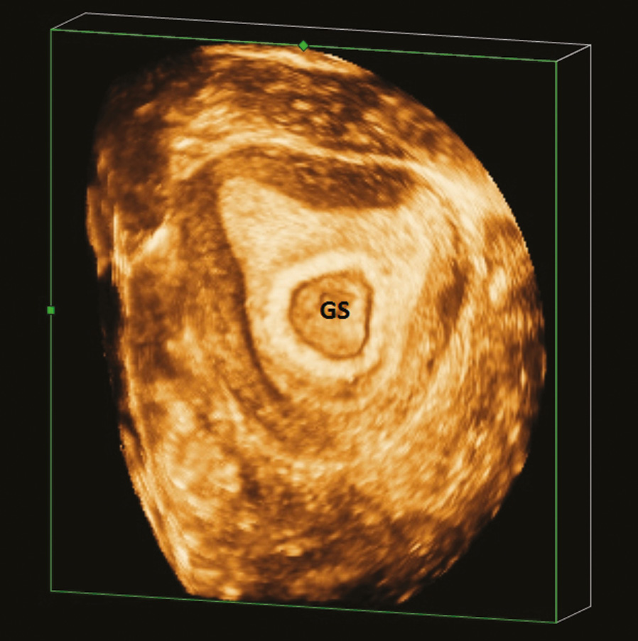 The tubal ring and ring of fire signs | Abdominal Radiology