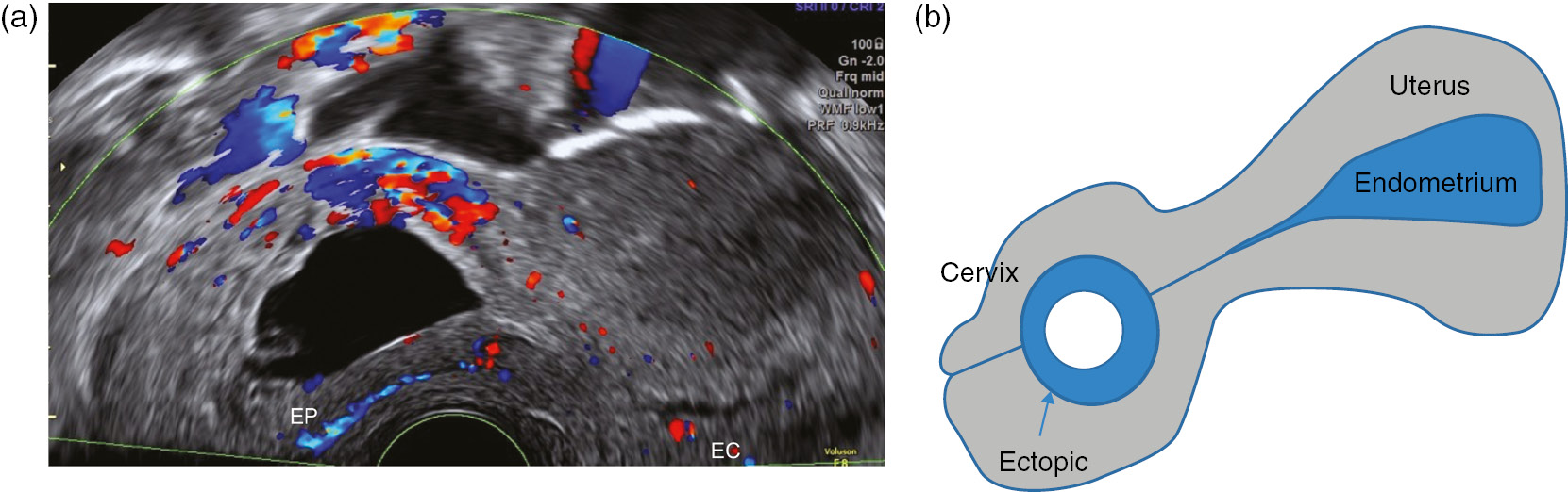 Cureus | Transvaginal Ultrasound Diagnosis of Ovarian Ectopic Pregnancy |  Article