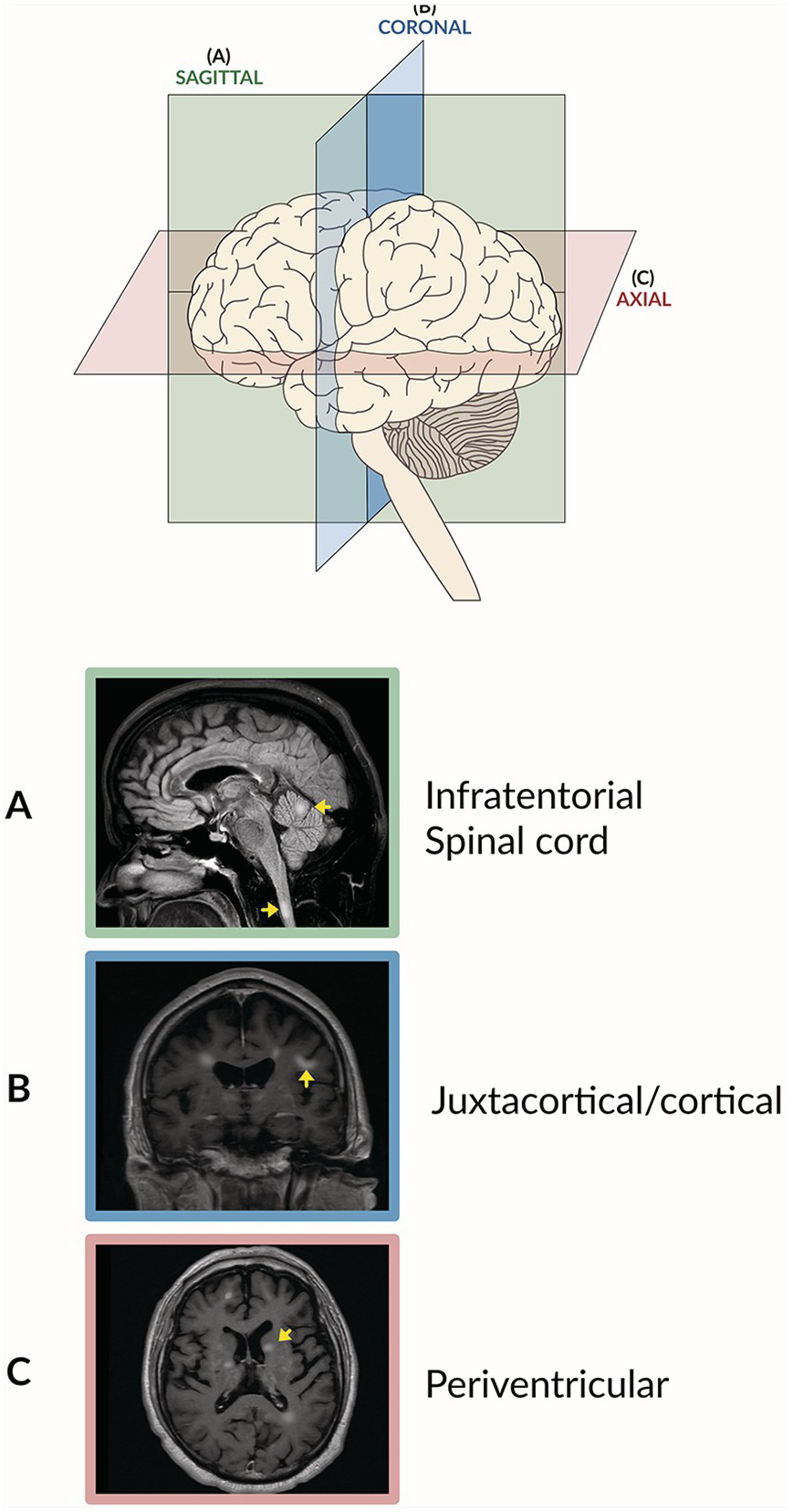 Imaging Surrogates of Disease Activity in Neuromyelitis Optica Allow  Distinction from Multiple Sclerosis