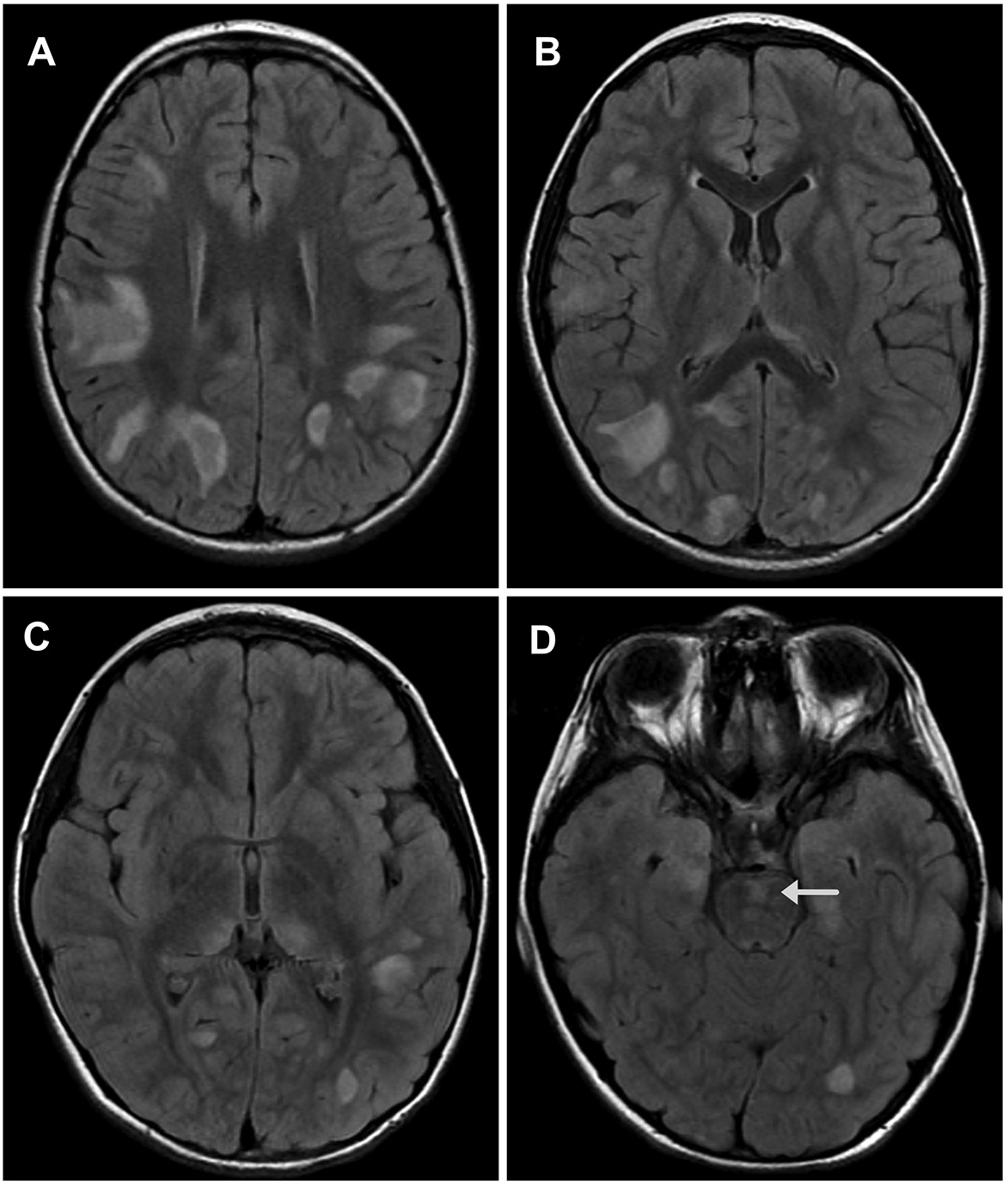 Imaging Surrogates of Disease Activity in Neuromyelitis Optica Allow  Distinction from Multiple Sclerosis