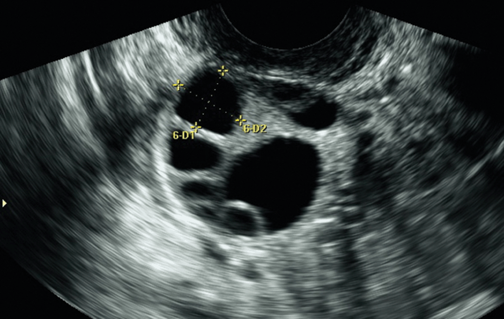 graafian follicle ultrasound