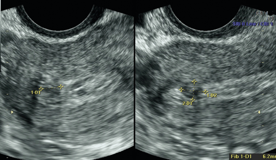 Uterine Pathology and Anomalies (Chapter 4) - Ultrasound in