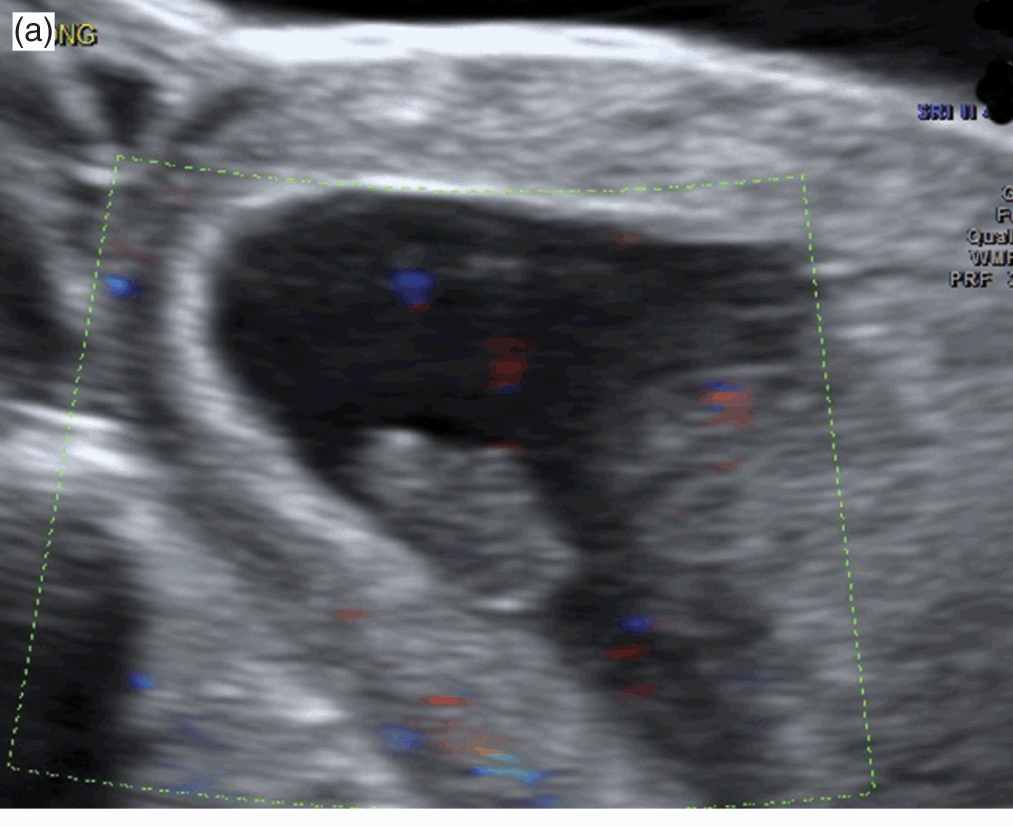 First Trimester Pregnancy Chapter 9 Ultrasound In Assisted Reproduction And Early Pregnancy