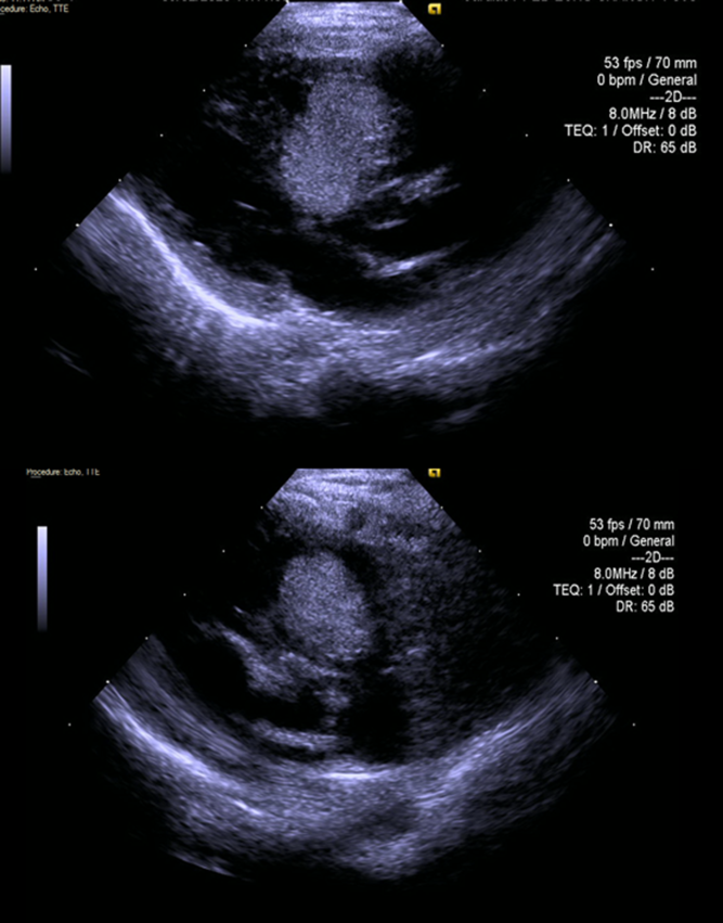 Rapid Response Of A Cardiac Rhabdomyoma Causing Severe Right 