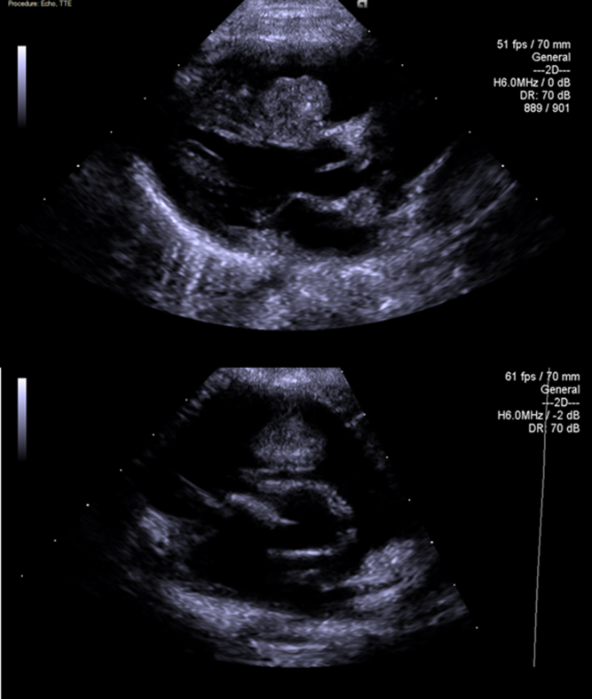 Rapid response of a cardiac rhabdomyoma causing severe right ...