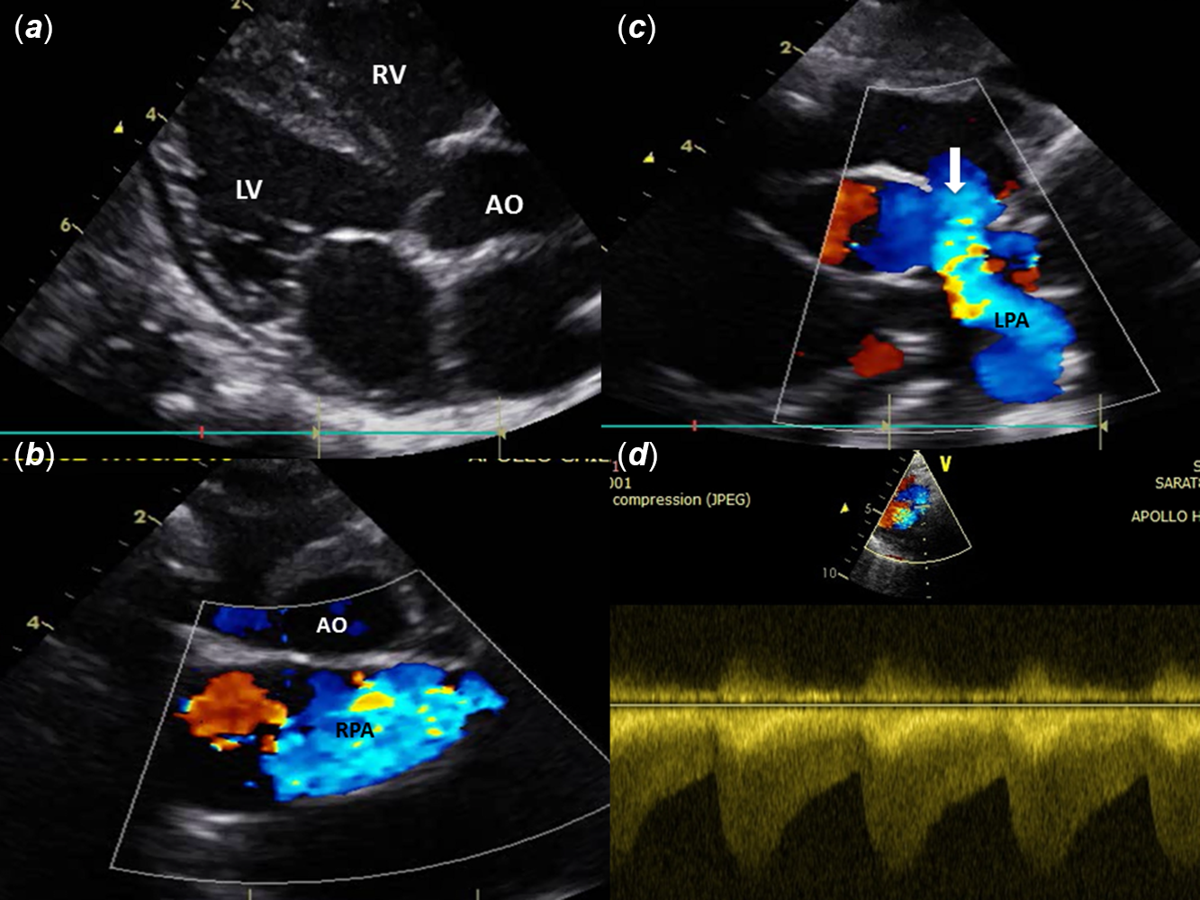 Fallot-type absent pulmonary valve syndrome with patent ductus ...
