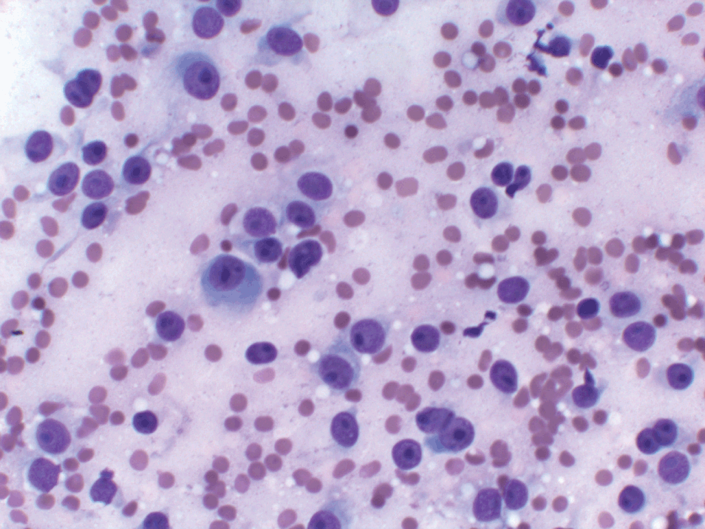 Cytopathological characteristics of solitary fibrous tumour involving the  pancreas by fine needle aspiration: Making an accurate preoperative  diagnosis in an uncommon location - Jones - 2022 - Cytopathology - Wiley  Online Library