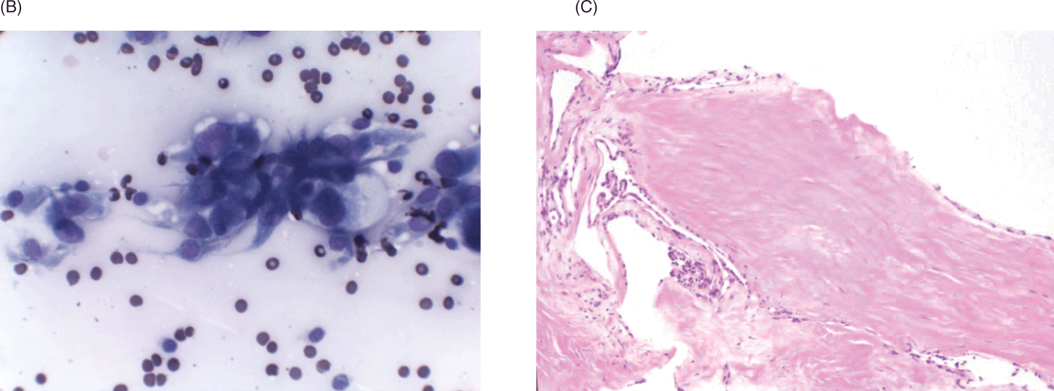 Cytopathological characteristics of solitary fibrous tumour involving the  pancreas by fine needle aspiration: Making an accurate preoperative  diagnosis in an uncommon location - Jones - 2022 - Cytopathology - Wiley  Online Library