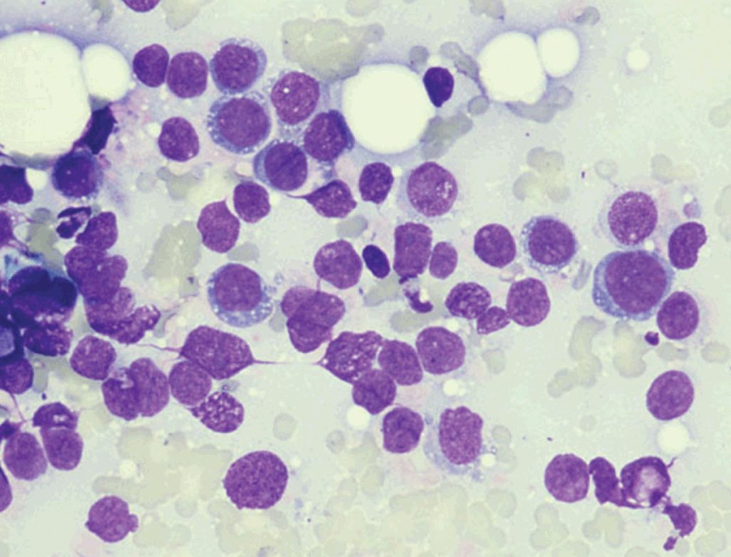 Cytopathological characteristics of solitary fibrous tumour involving the  pancreas by fine needle aspiration: Making an accurate preoperative  diagnosis in an uncommon location - Jones - 2022 - Cytopathology - Wiley  Online Library