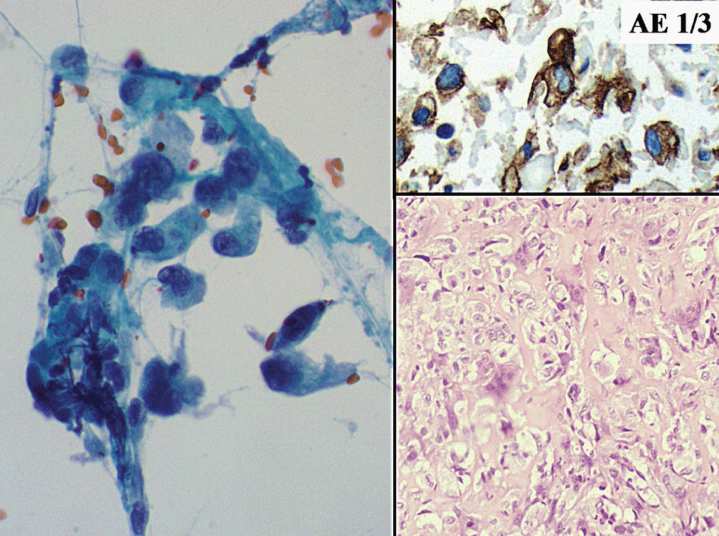 Cytopathological characteristics of solitary fibrous tumour involving the  pancreas by fine needle aspiration: Making an accurate preoperative  diagnosis in an uncommon location - Jones - 2022 - Cytopathology - Wiley  Online Library
