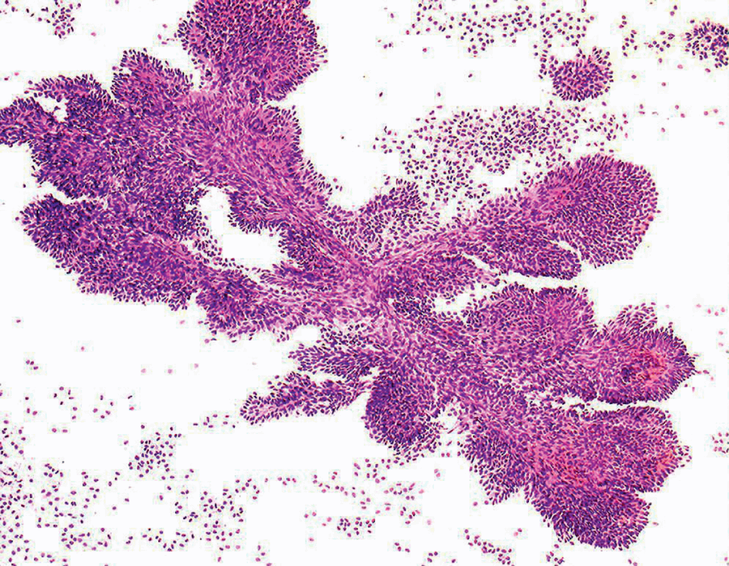 Cytopathology of Central Nervous System (Chapter 7) - Differential  Diagnosis in Cytopathology