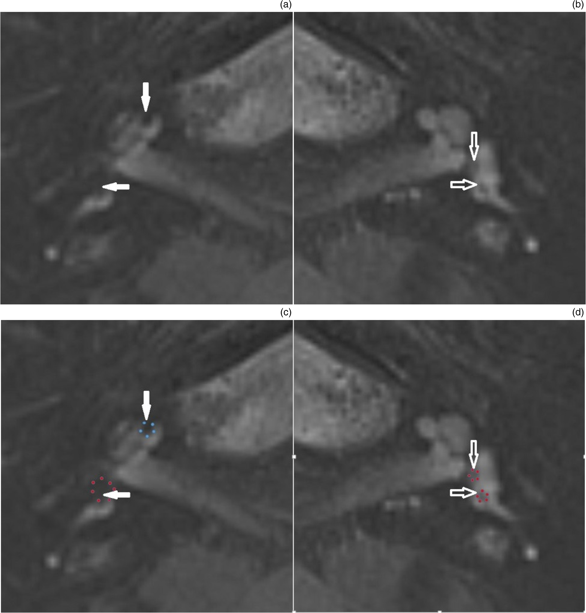 resonance imaging of Ménière's disease early clinical