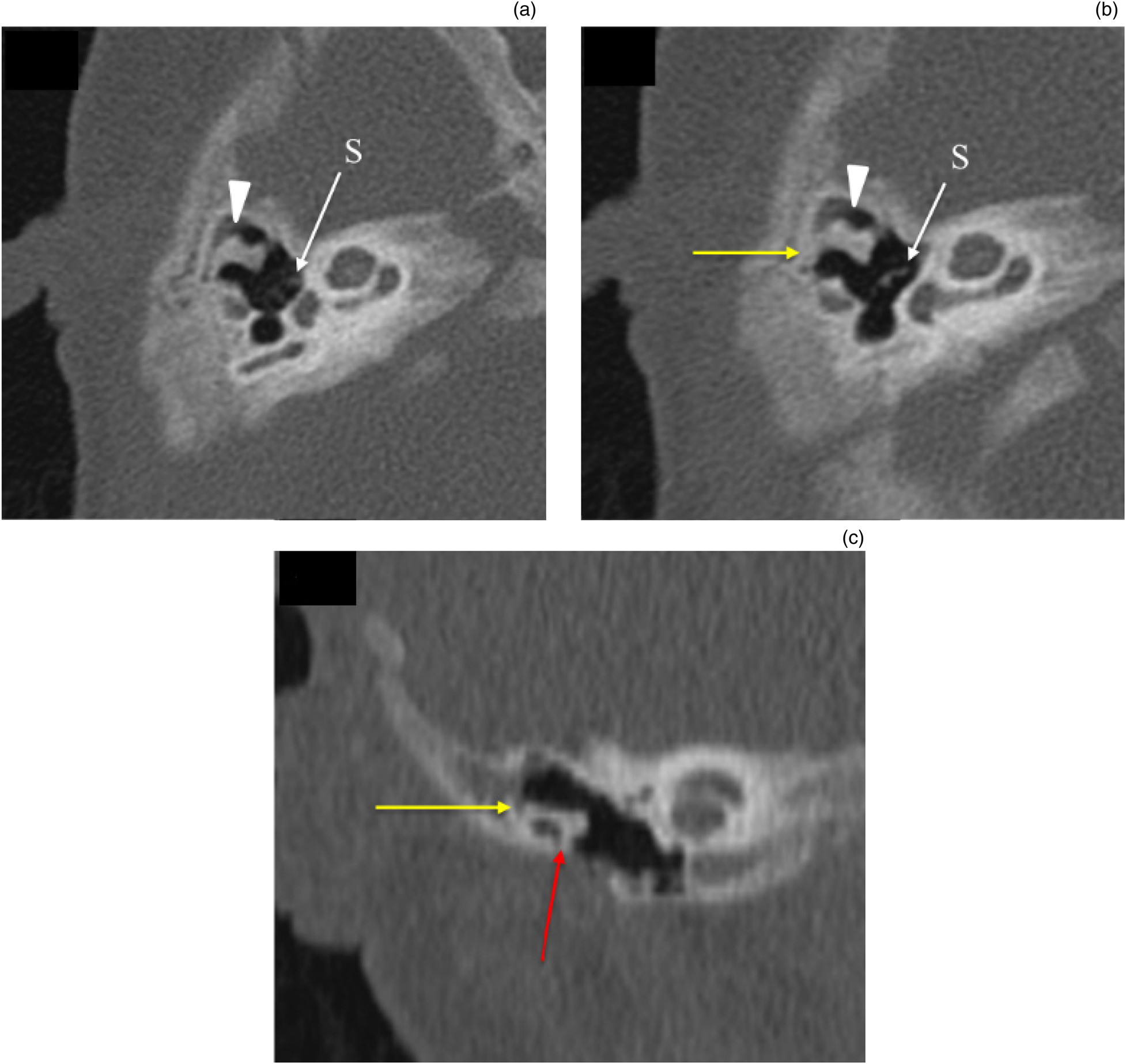 Stapes, Radiology Reference Article