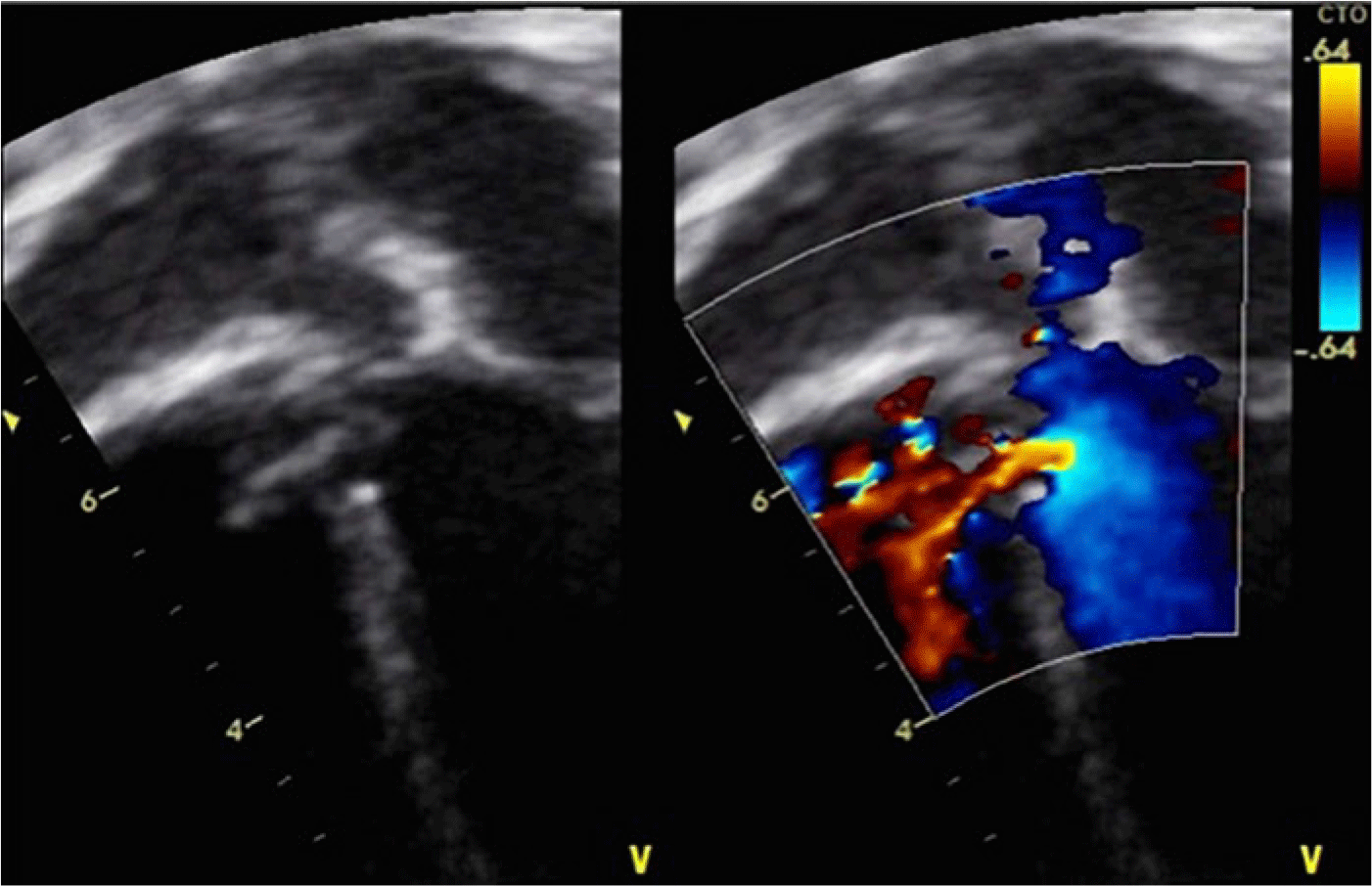 Procedural And Short-term Outcomes Of Transcatheter Closure Of ...