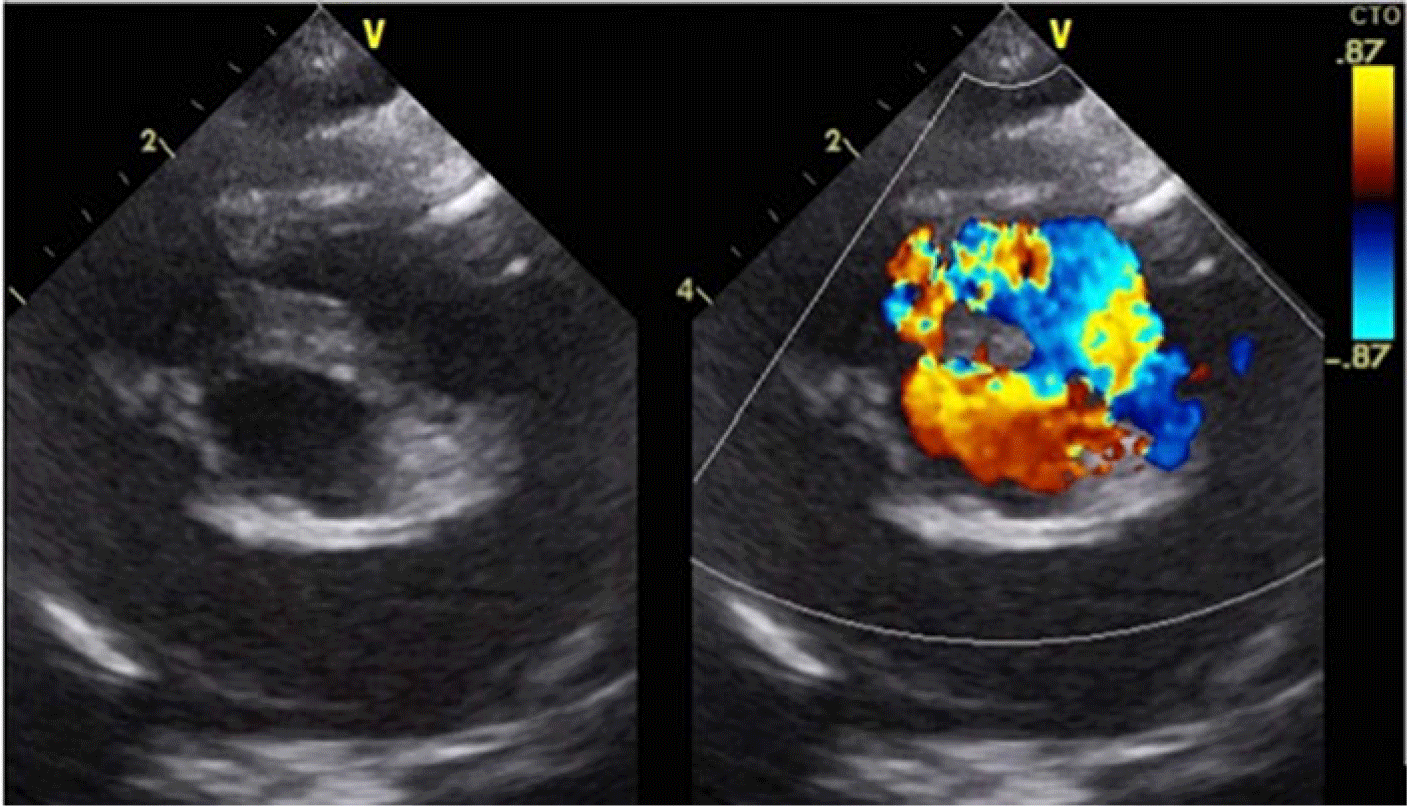 Procedural And Short-term Outcomes Of Transcatheter Closure Of ...