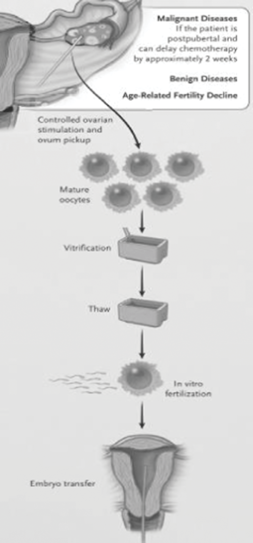 Fertility Preservation in Women with Ovarian Endometriomas (Chapter 8) -  Fertility Preservation