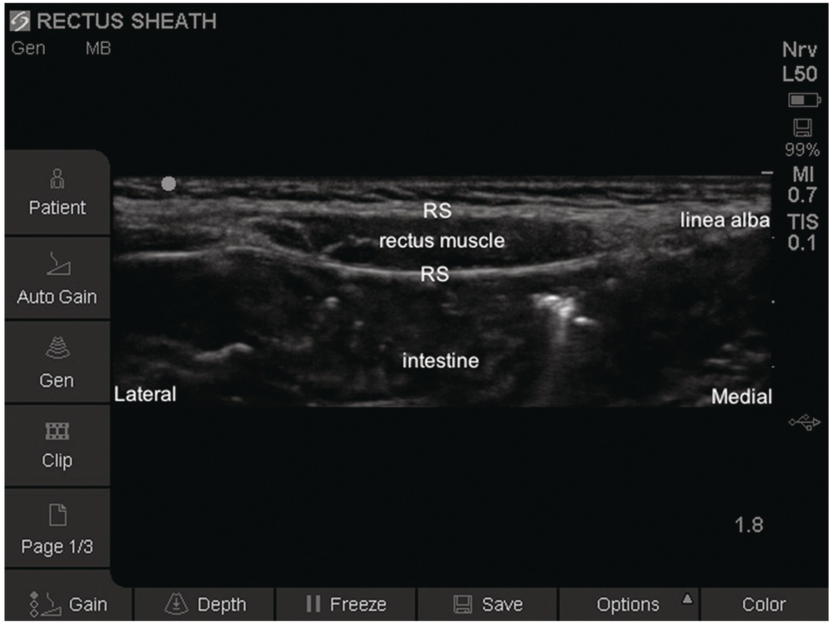 Analgesia for iliac crest bone graft (Chapter 34) - Decision-Making in  Orthopedic and Regional Anesthesiology