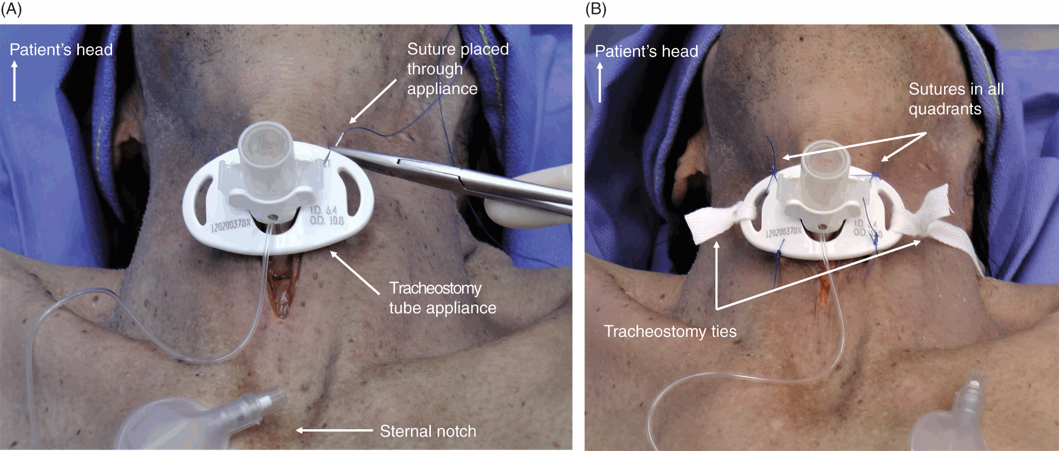 The Suture Buddy Kit with Port Holes