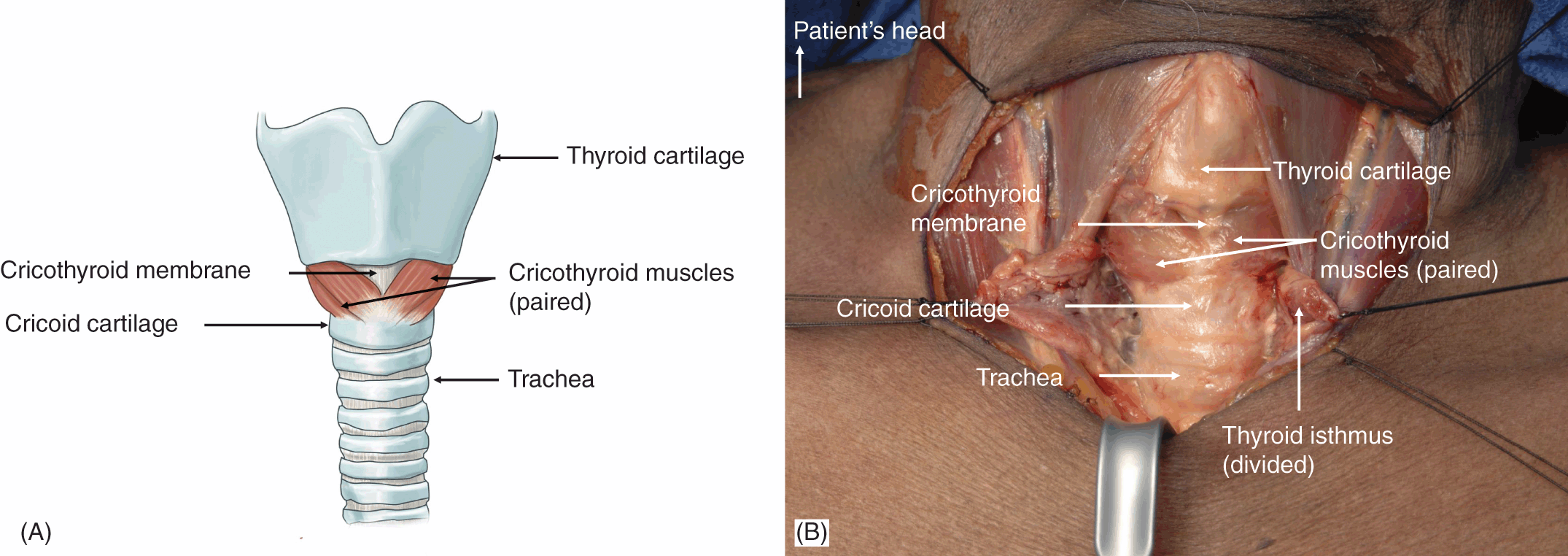 tracheostomy vs cricothyrotomy