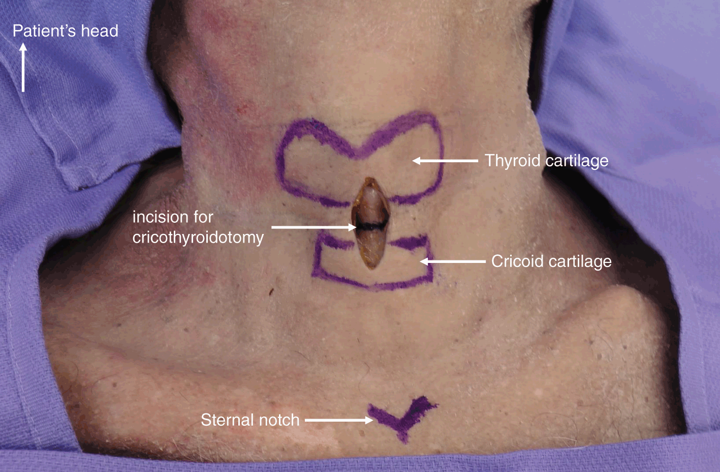 cricothyroid membrane incision