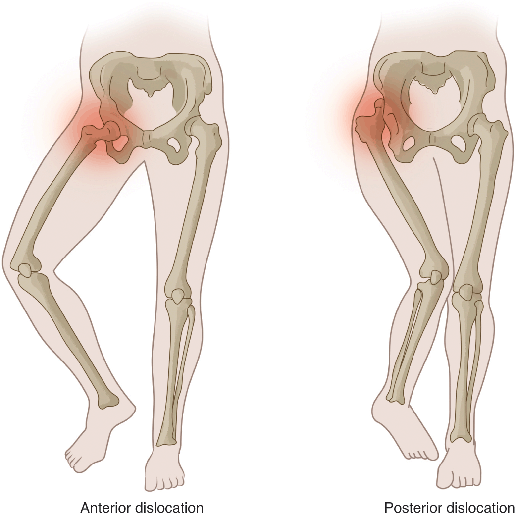 Extremity Compartment Syndrome (Chapter 10) - Color Atlas of