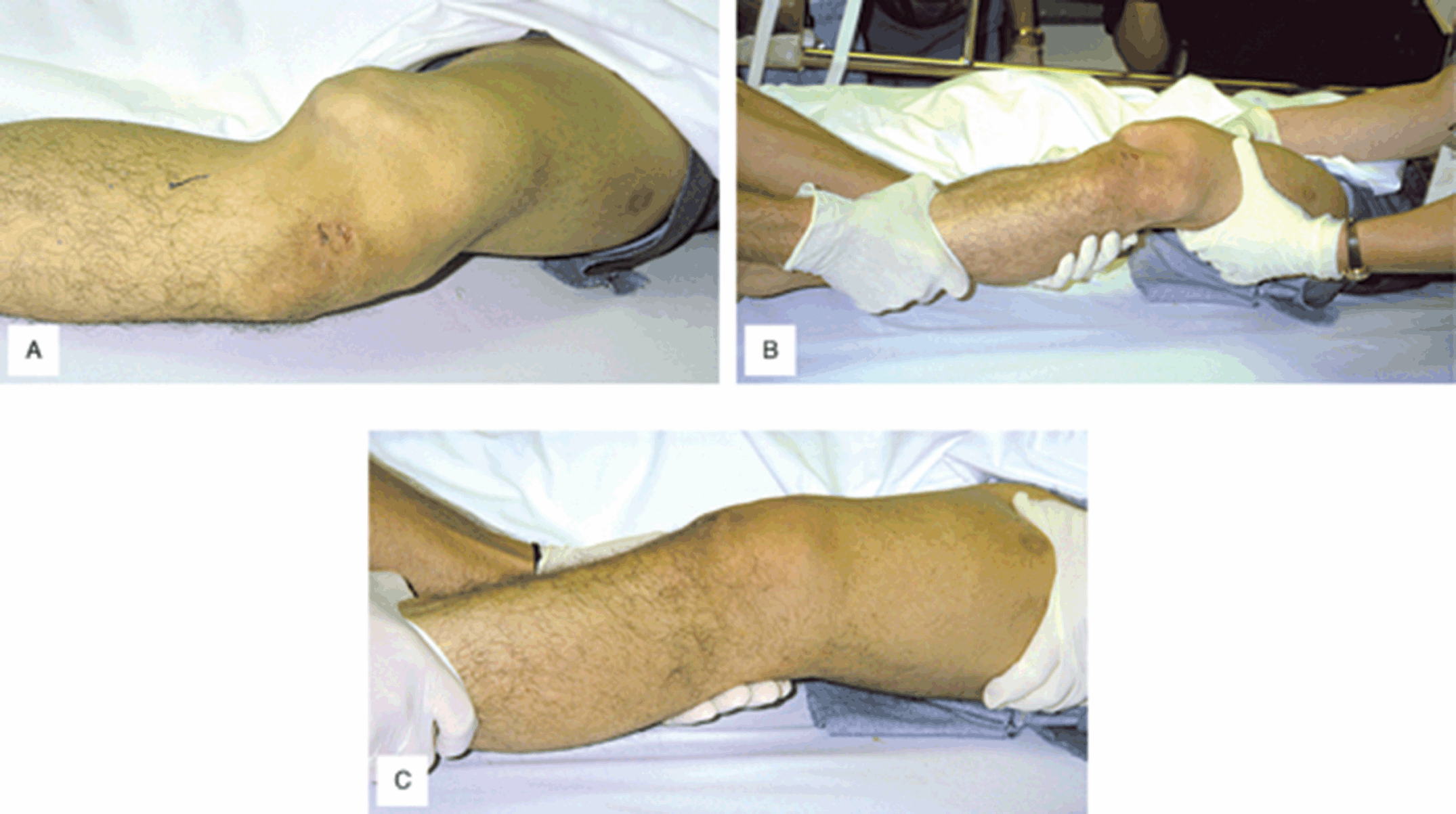 Extremity Compartment Syndrome (Chapter 10) - Color Atlas of