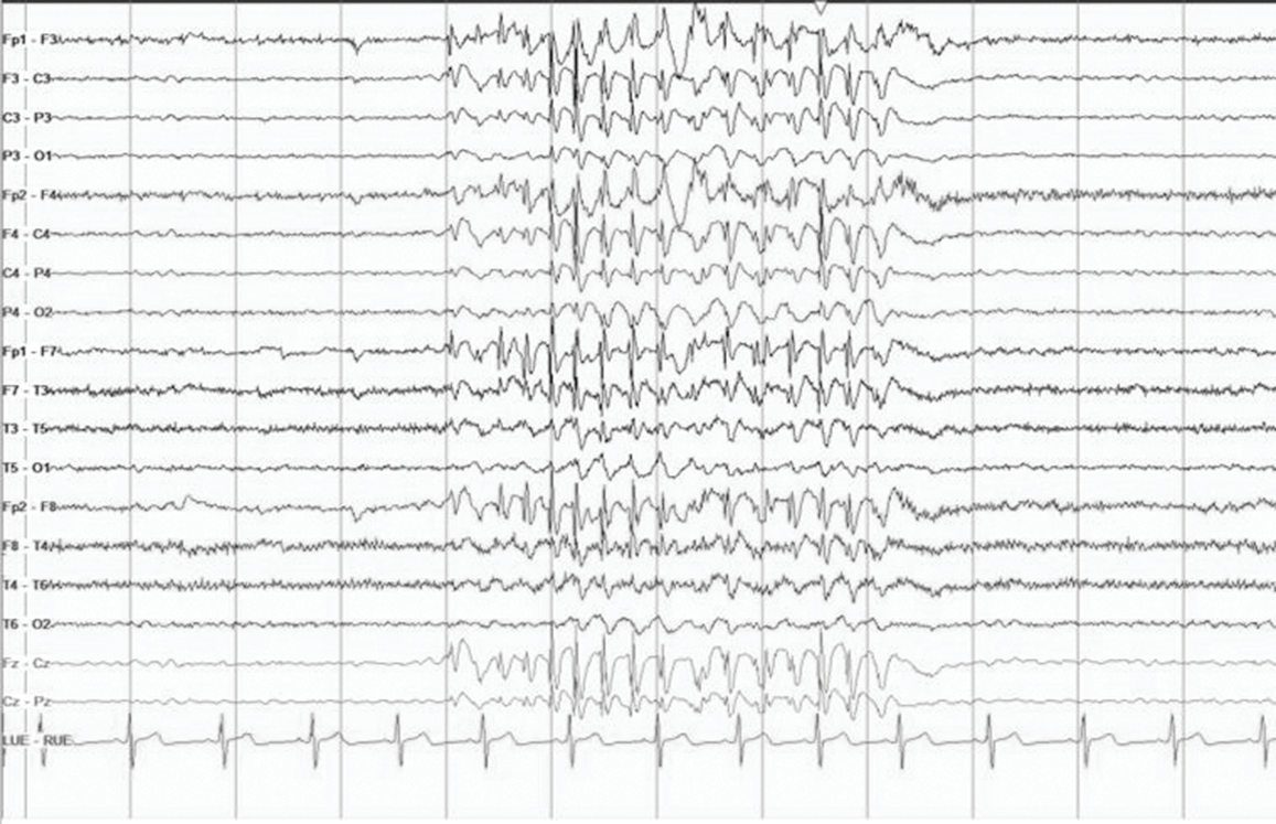 absence seizure eeg