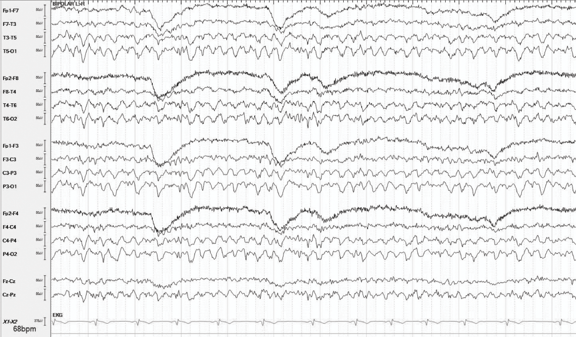 Basics (Part I) - How to Read an EEG