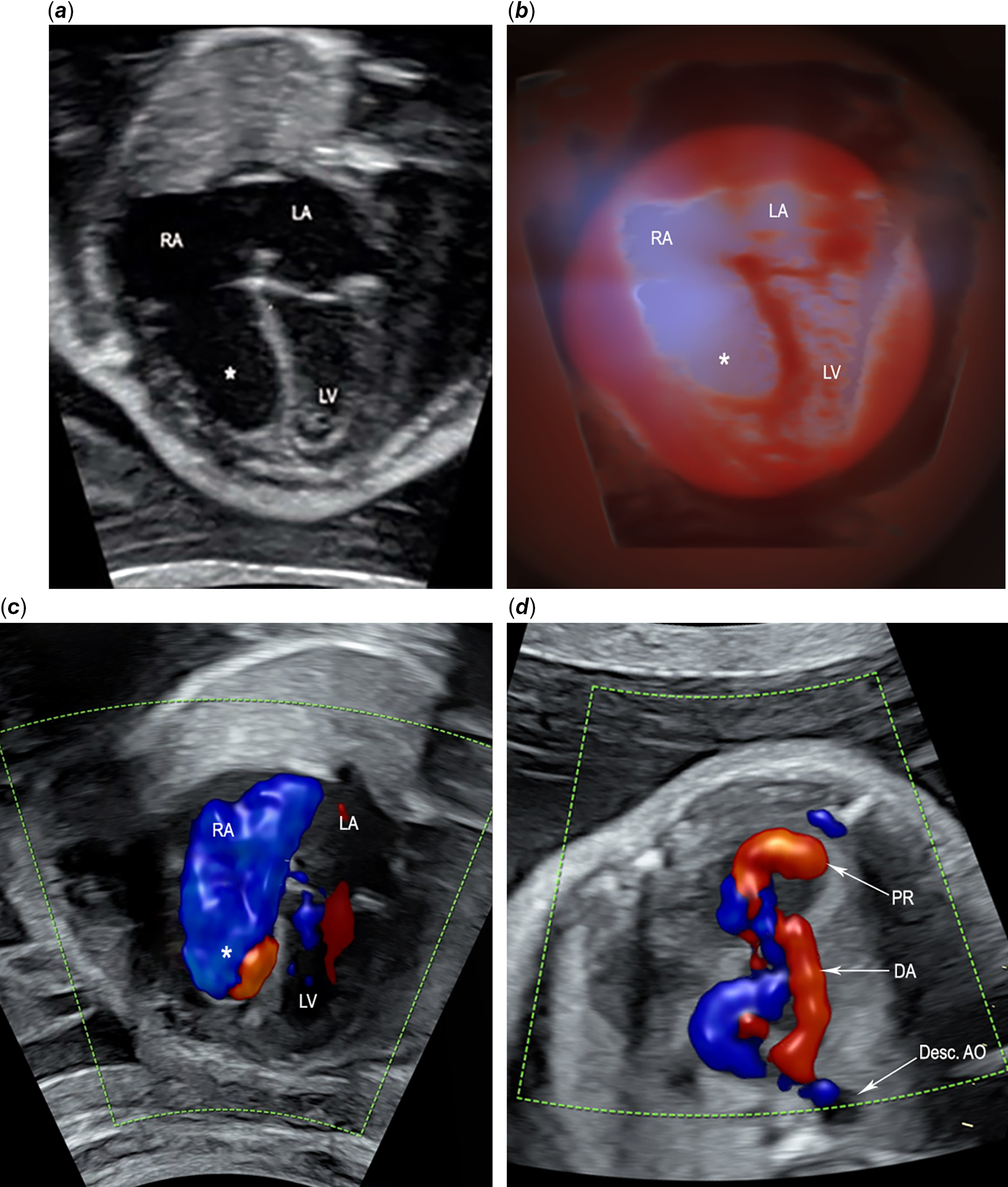 RV Global Longitudinal Strain a Predictor of Mortality in Ebstein