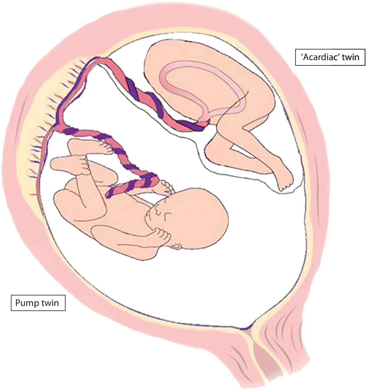 Multiple Pregnancy Content Last Reviewed 14th December Chapter 55 High Risk Pregnancy