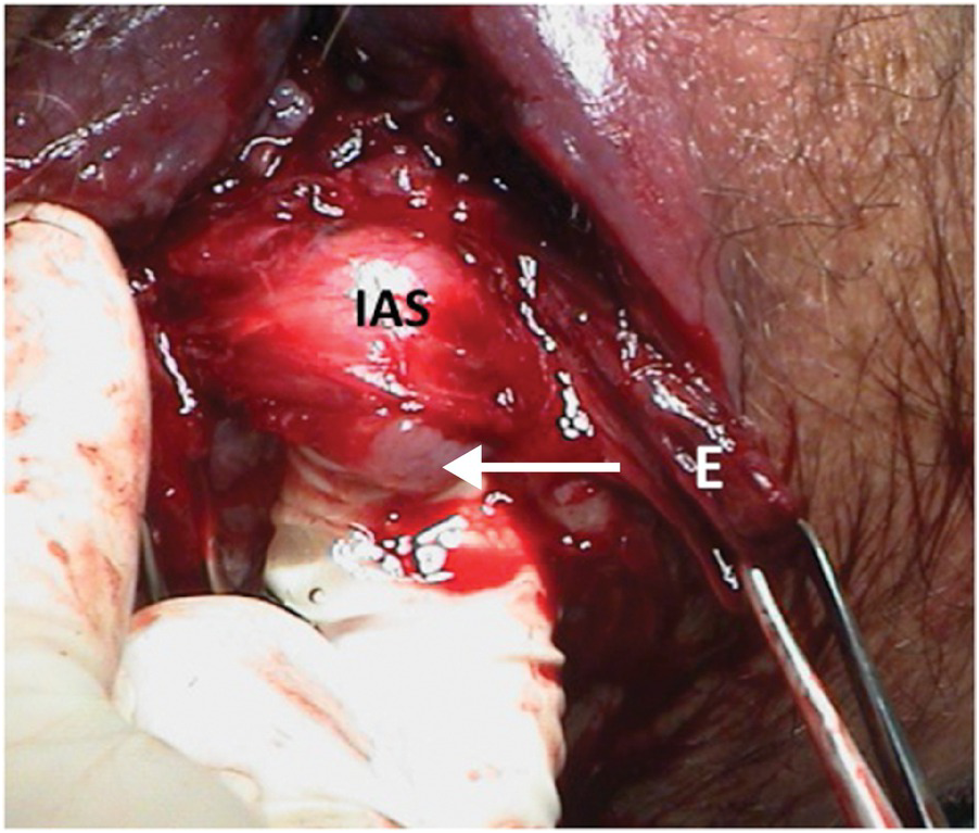 Bilateral Massive Hematoma of Bartholin Glands after Prolonged Labour: A  Case Report