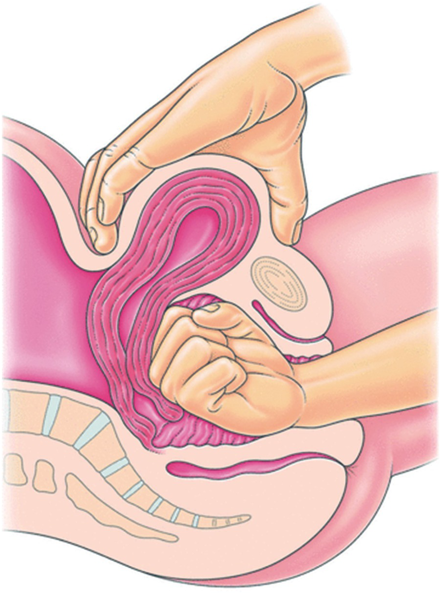 JAMA on X: Uterine prolapse occurs when the uterus drops into the vagina.  This JAMA Patient Page discusses diagnosis and treatment options for uterine  prolapse.   / X