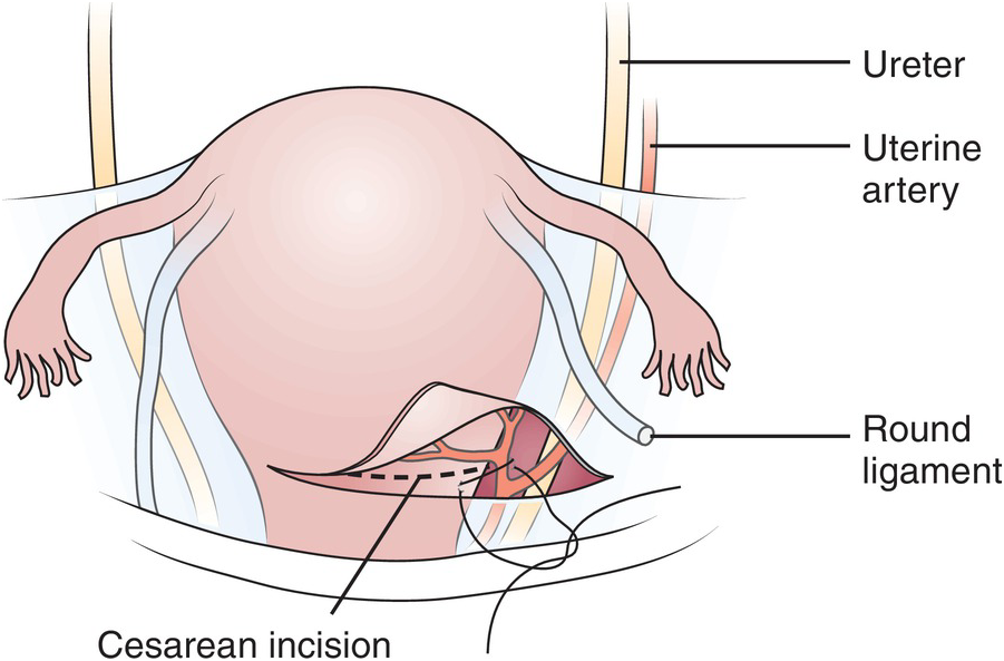 Uterus Inflation