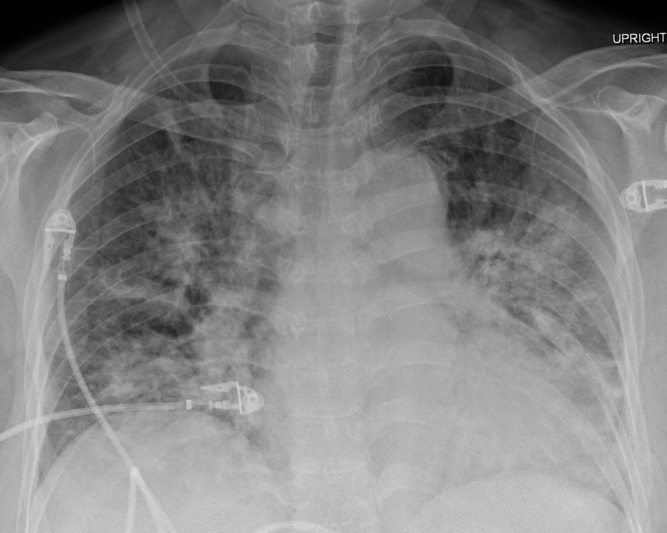 Pneumocystis Jirovecii Prophylaxis in Neurosurgery | Canadian Journal ...