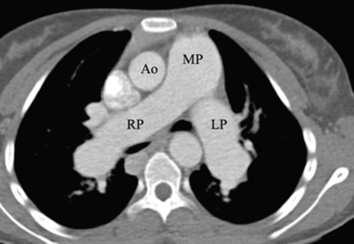 The multisystem nature of isomerism left isomerism complicated by