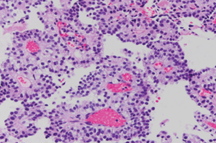 Congenital and Perinatal Brain Tumors (Chapter 48)