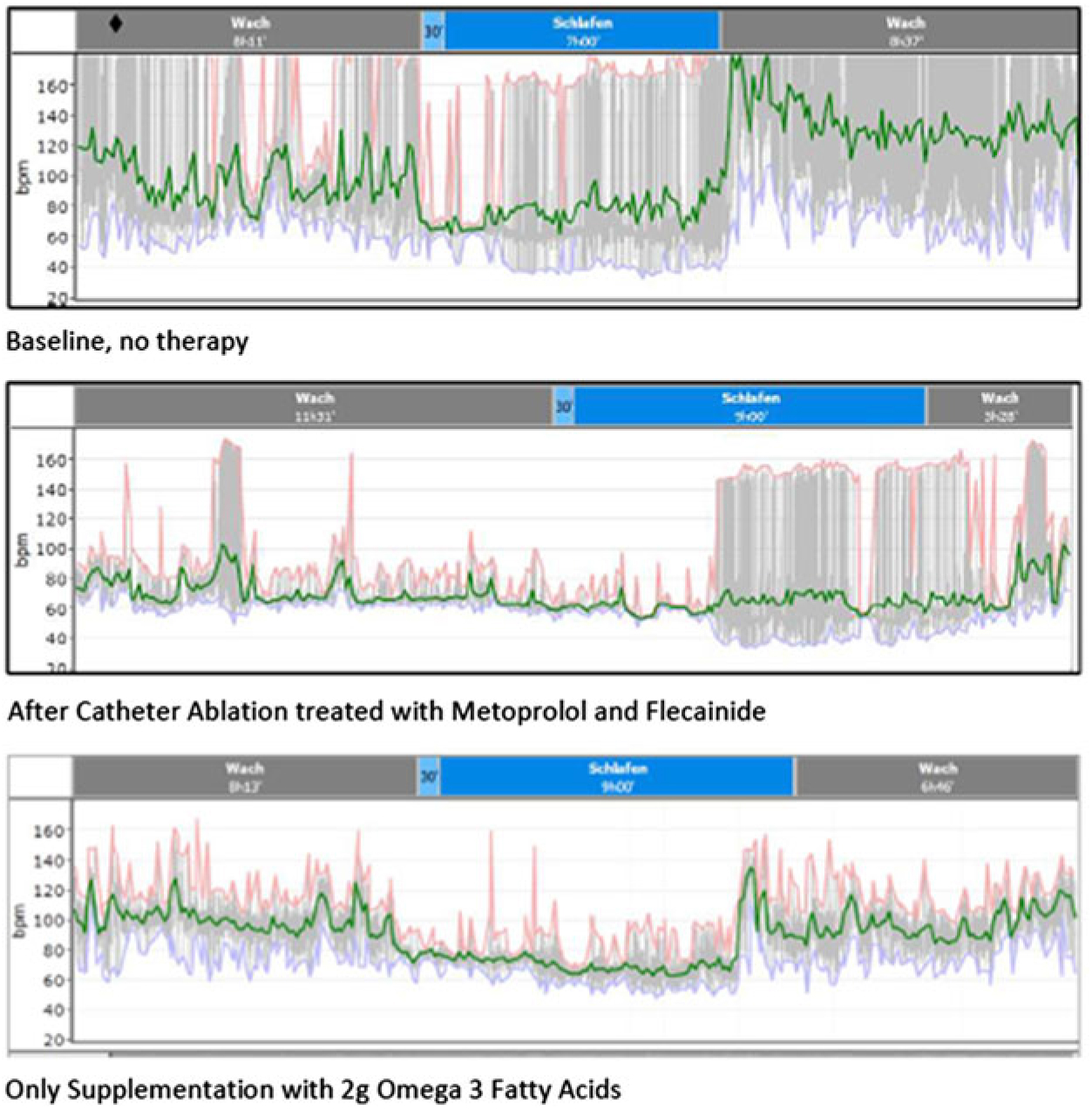 Resolution of a therapy resistant focal atrial tachycardia after