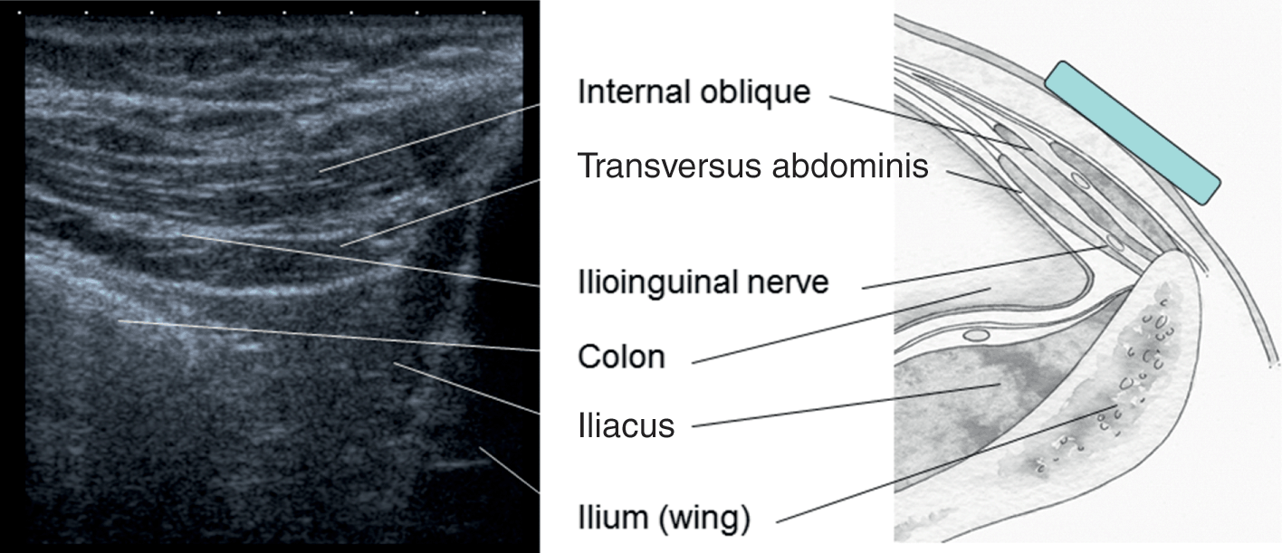ilioinguinal nerve block ultrasound