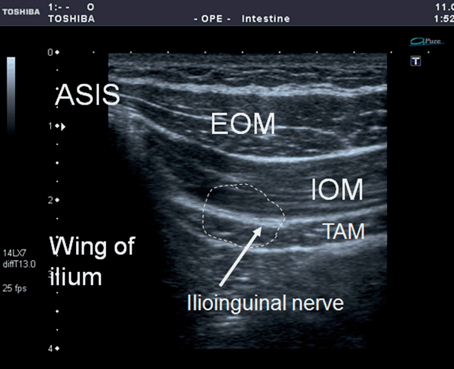 Ultrasound-Guided Peripheral Nerve Stimulation