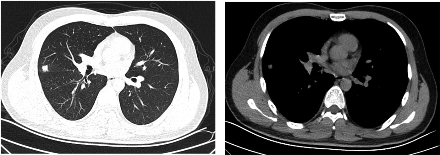 Adenovirus pneumonia should not be overlooked in immunocompetent youths ...