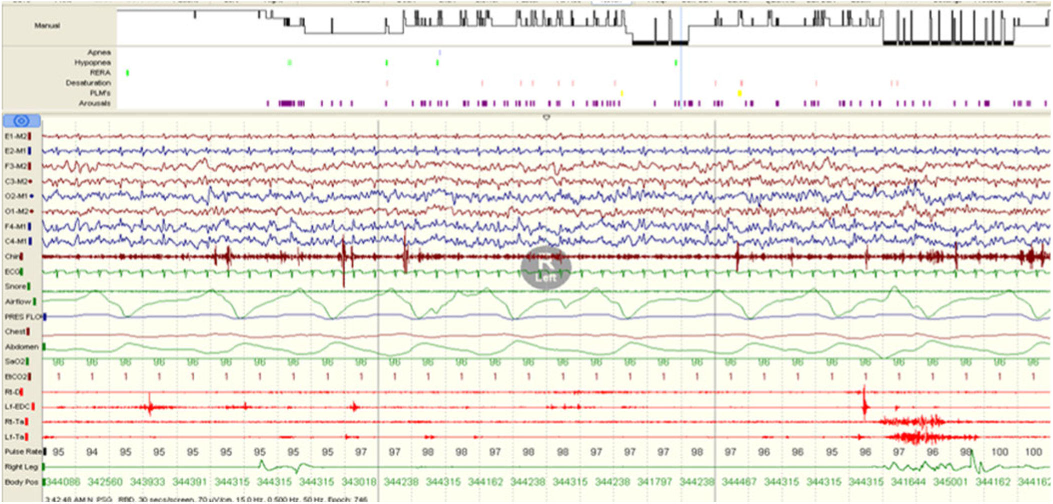 Rapid Eye Movement (REM) Sleep Behavior Disorder and REM Sleep with