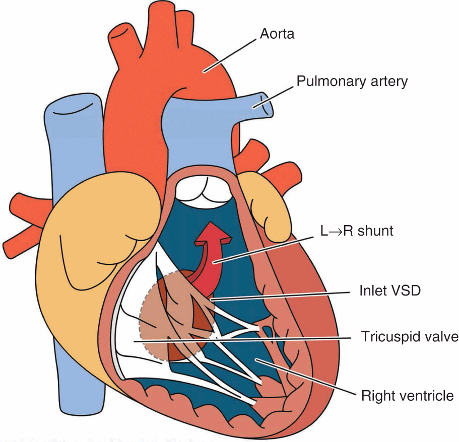 Braz J Cardiovasc Surg - The pulmonary vascular blood supply in the  pulmonary atresia with ventricular septal defect and its implications in  surgical treatment