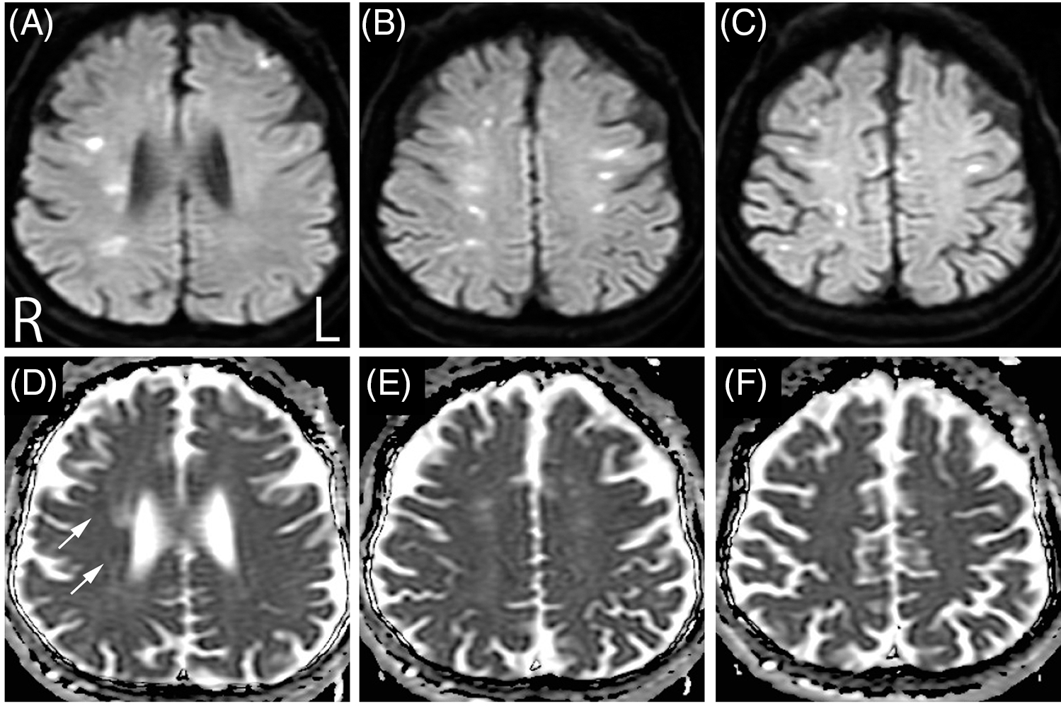 Numerous Hyperintense Cerebral White Matter Lesions on Diffusion ...